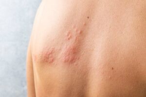 Investigadores de Stanford revelan que la vacuna contra el herpes zóster reduce un 20% el riesgo de demencia