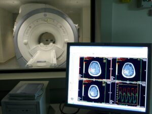 Test en sangre diagnostica el Alzheimer y mide el avance de la enfermedad