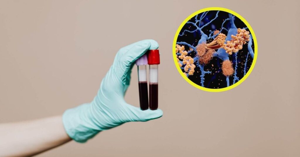 este análisis de sangre permite detectar si tienes o tendrás alzhéimer antes de que tú lo notes
