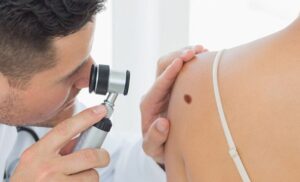 Día Mundial contra el Melanoma: una fecha clave para la prevención del cáncer de piel