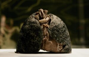 La falta de conocimiento del paciente retrasa el diagnóstico del cáncer de pulmón