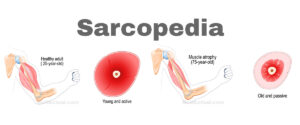 Suplementos que podrían ayudar a combatir la sarcopenia o pérdida de masa muscular