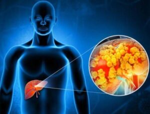 dos síntomas del cáncer de hígado que se pueden identificar mientras estás en el baño