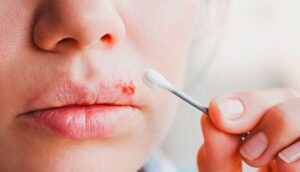 ¿Puede el herpes labial aumentar el riesgo de alzhéimer? lo que reveló un estudio con 700 mil pacientes