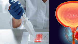 Descubren un gen en cáncer de próstata agresivo que podría abrir nuevas vías de tratamiento