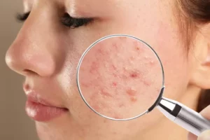 Día Mundial de la Hidradenitis Supurativa promueve el diagnóstico temprano