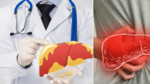 Los síntomas más comunes del hígado graso y cinco hábitos para prevenirlo, según expertos