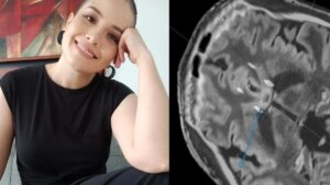 ¿Existe cirugía para mejorar la depresión? La historia de la mujer que se sometió a procedimiento cerebral pionero