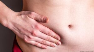 ¿Por qué el cáncer de apéndice aumenta en los jóvenes? – DW – 17/06/2025