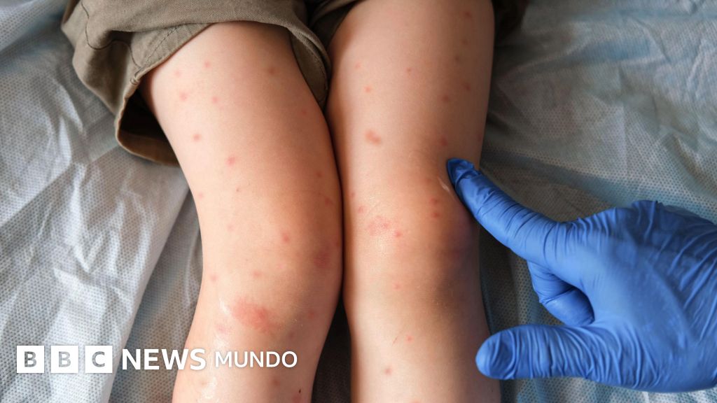 Cómo la desinformación sobre las vacunas convirtió a Canadá en el epicentro del sarampión en Norteamérica