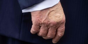 Detectan a Trump hinchazón en las piernas y un moratón en una mano por «estrechar muchas»