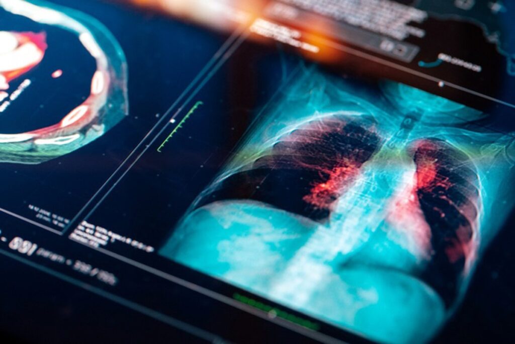 Un estudio concluye que la contaminación del aire promueve el cáncer de pulmón en no fumadores