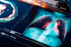Un estudio concluye que la contaminación del aire promueve el cáncer de pulmón en no fumadores