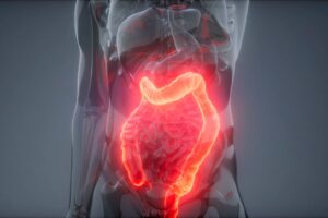 un trastorno común que limita vida social, según gastroenterólogo
