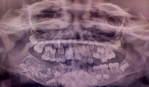 El increíble caso del niño al que le extrajeron 526 dientes en una sola cirugía