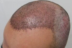 un turista murió tras una intervención de trasplante de pelo