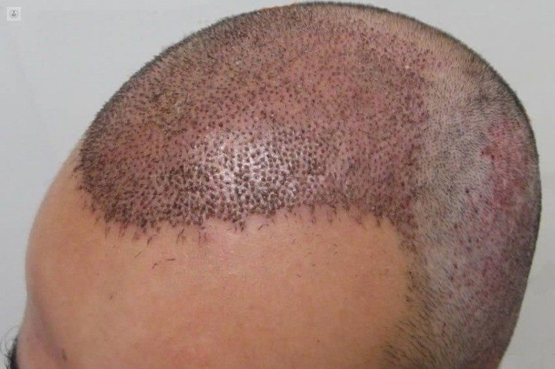 un turista murió tras una intervención de trasplante de pelo