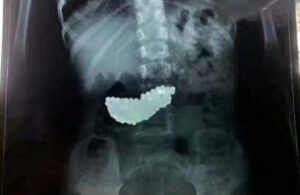 Médicos salvaron a una niña que se había tragado 134 bolas magnéticas