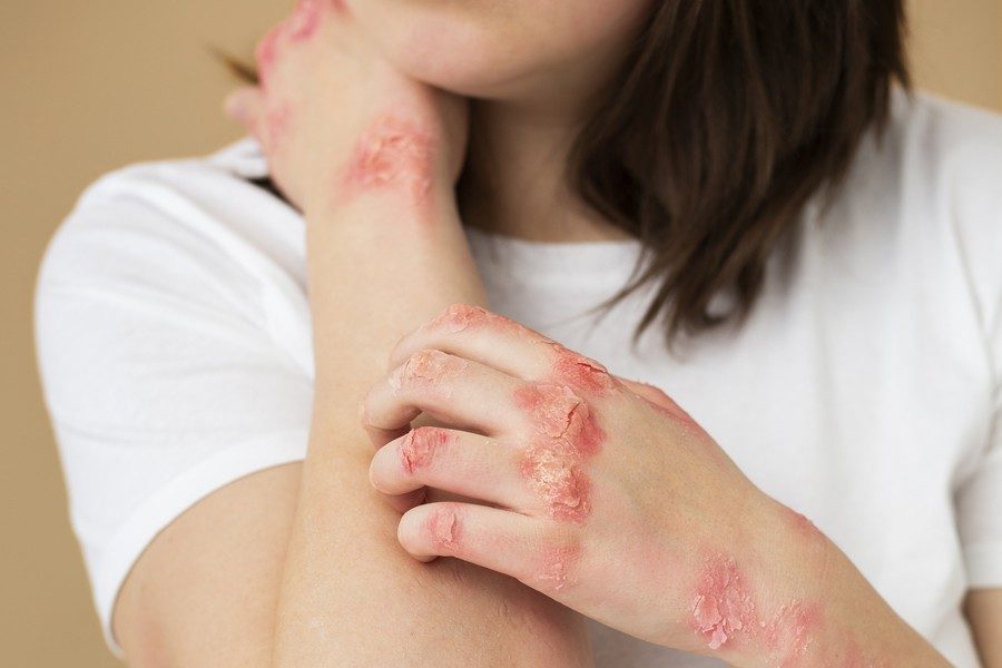 Se disparan la dermatitis seborreica y la psoriasis por el estrés