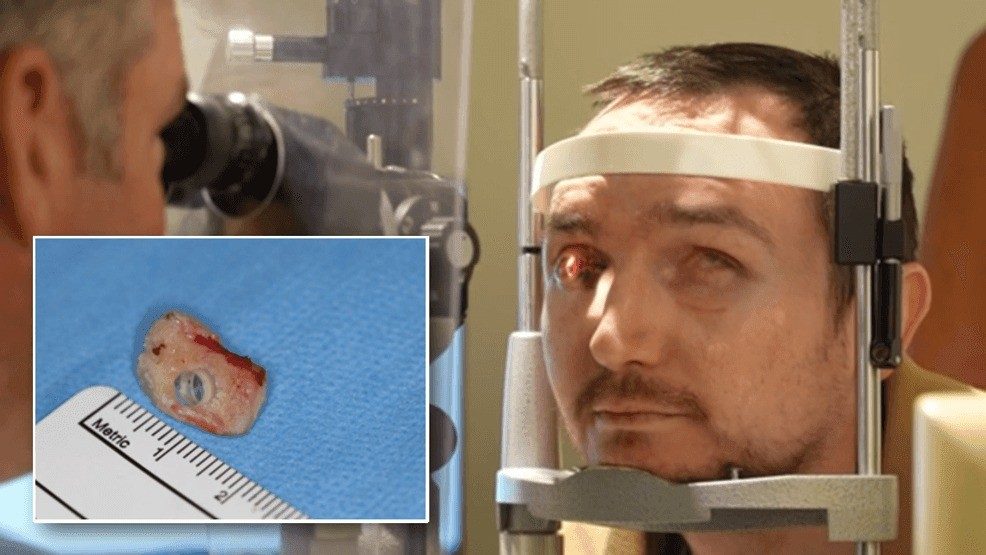 Una alergia al ibuprofeno lo dejó ciego y le implantaron un diente en el ojo para recuperar la visión