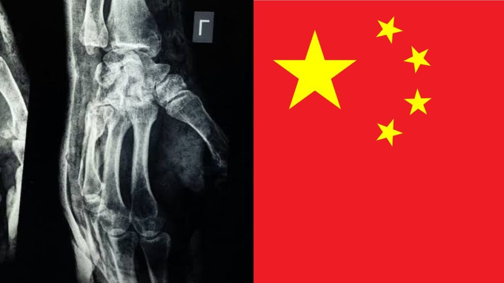 científicos en China crearon un gel que repara fracturas en tres minutos