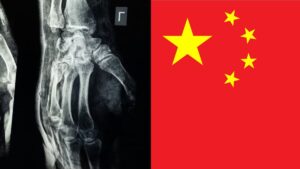 científicos en China crearon un gel que repara fracturas en tres minutos