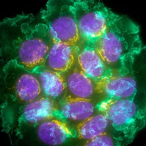 Así es el cáncer en etapa 0: el aviso silencioso del cuerpo que podría salvarte la vida | National Geographic