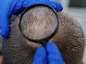 Dermatólogo explicó la relación entre las canas y el riesgo de padecimiento de cáncer