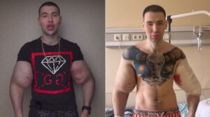 Influencer se inyectó vaselina en los bíceps para parecerse a «Popeye» y ahora podría perder ambos brazos