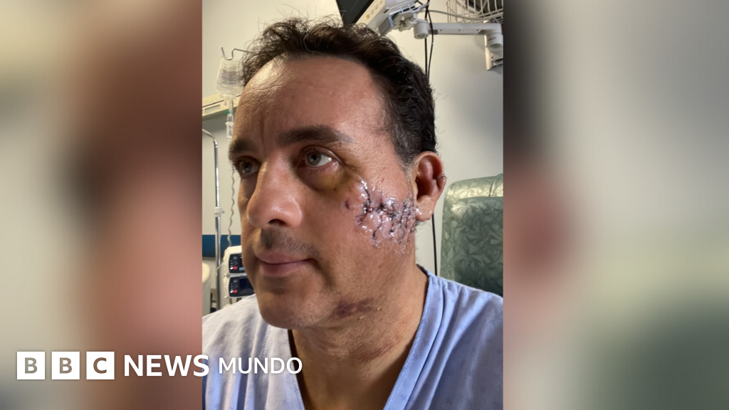 "Me perdonó la vida": el impresionante relato del mexicano que sobrevivió a la mordida de un tiburón en la cabeza
