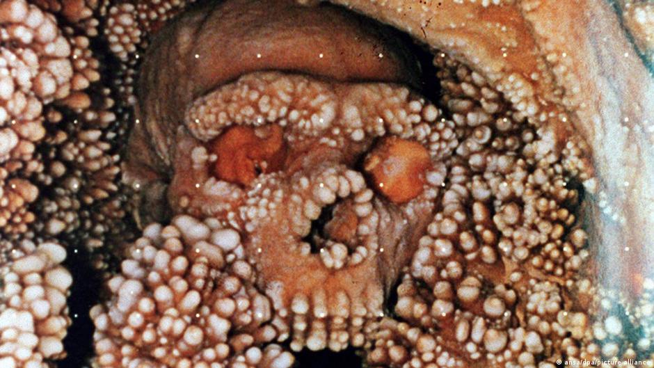Neandertal de Altamura desvela sus secretos tras 30 años – DW – 19/11/2025
