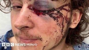 «Los médicos dicen que estoy vivo de milagro»: el joven que perdió un ojo durante una protesta contra ICE en California