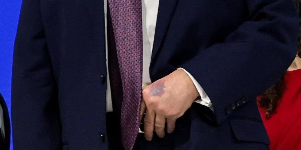 Trump aparece con un moratón en la mano durante su participación en Davos