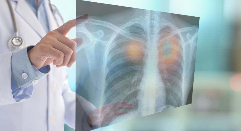 Investigadores descubren que algunas anomalías en tomografías de pulmón pueden revelar la presencia de otros tipos de cáncer