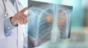 Investigadores descubren que algunas anomalías en tomografías de pulmón pueden revelar la presencia de otros tipos de cáncer