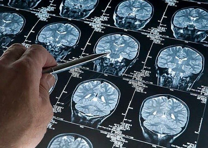 Desarrollan una plataforma que detecta el alzhéimer de forma precoz a través de la voz