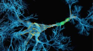 descubren que la inflamación causada por la esclerosis múltiple daña el ADN de las neuronas