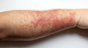 ¿Y si tu problema de piel estuviera afectando más de lo que crees? La dermatitis atópica puede influir en el estrés, la ansiedad y tu rendimiento diario