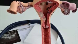 Asociación mexicana pide priorizar la atención del cáncer de ovario