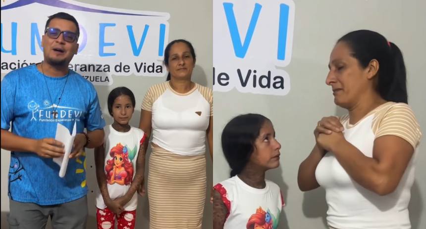 Darán atención médica a Angélica, la niña que se viralizó tras extraña condición en la piel: Será llevada a Caracas para realizar exámenes
