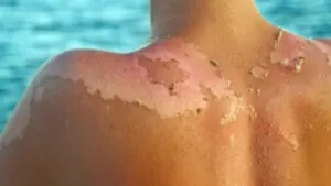 Especialistas llaman a cuidar la piel ante el aumento de las temperaturas