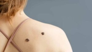 Sociedad Anticancerosa Aragua ofrecerá jornada de descarte de melanoma