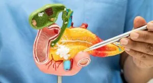 El avance médico que está sorprendiendo a los oncólogos: un tratamiento logra duplicar la supervivencia en cáncer de páncreas avanzado