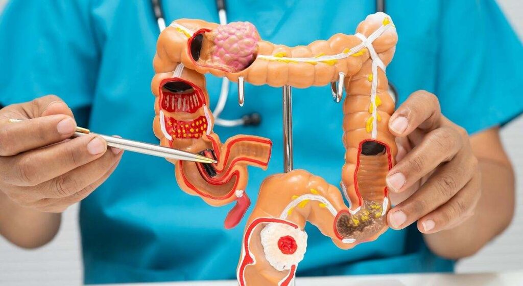 Los expertos encuentran una nueva vía para mejorar los resultados en pacientes con cáncer colorrectal avanzado