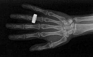 Primeras radiografías médicas hechas en el espacio