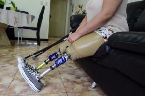 Sobrevivientes enfrentan amputaciones con un sistema desbordado
